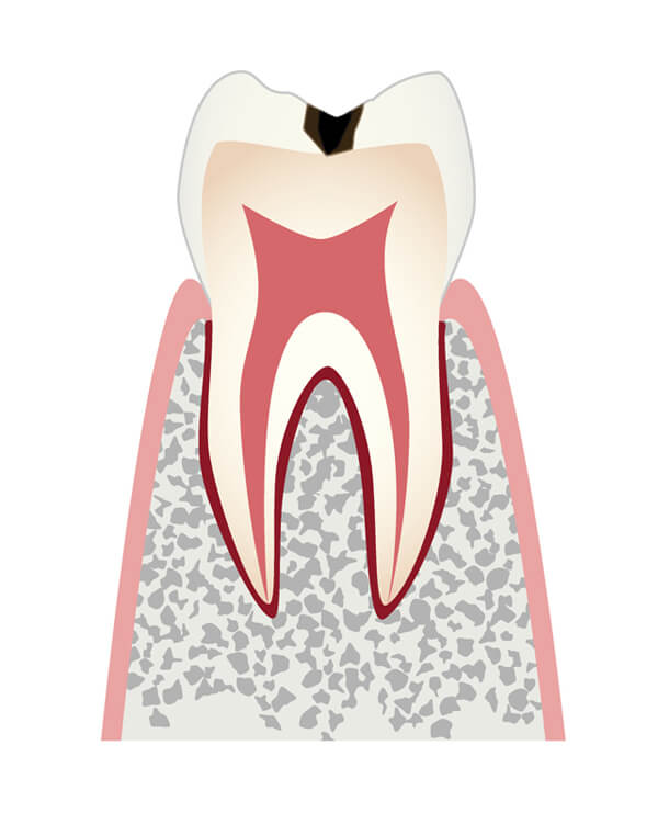 C1.初期のむし歯