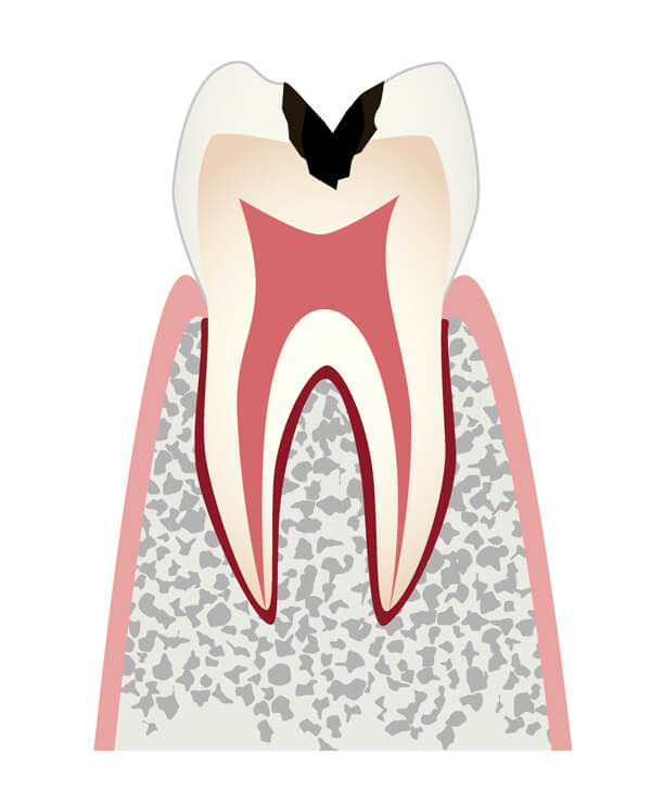 C2.歯の内部まで進行したむし歯