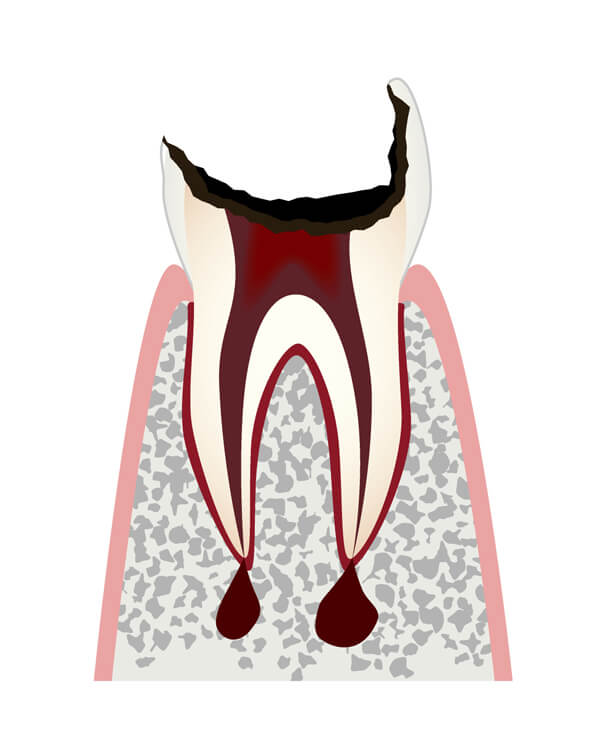 C4.歯の根（歯質）が失われた歯