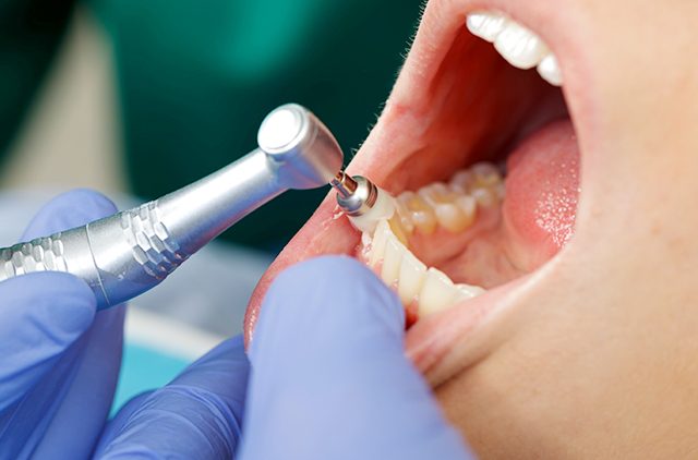 歯科での予防